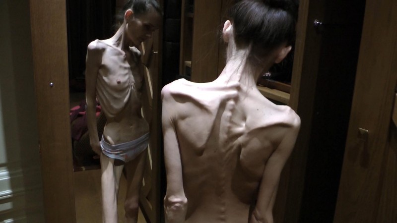 Skinnyfans Anorexic girls